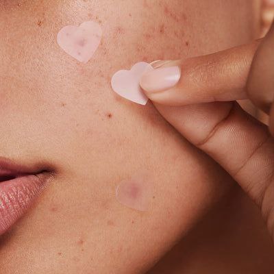 PARCHE PARA EL ACNE HIDROCOLOIDE, ABSORBE EL EXCESO DE LIQUIDO, GRASA Y PUS SECANDOLO RAPIDO KORMESIC 48UND